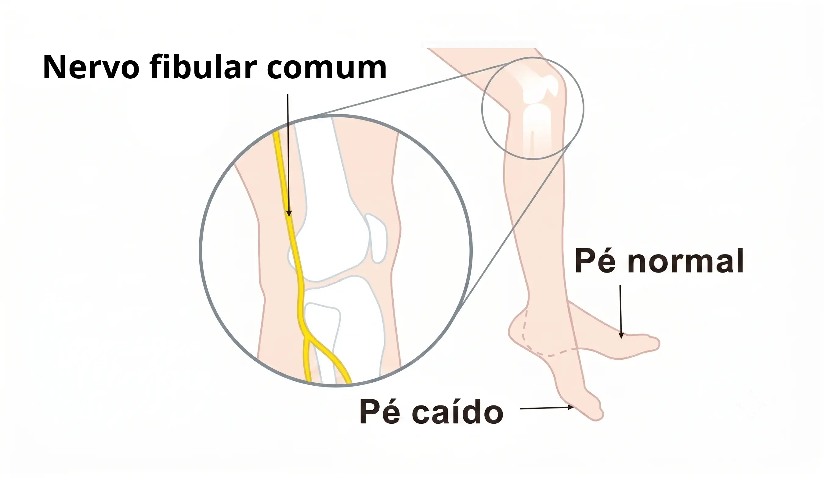 Diagrama anatômico do joelho mostrando o trajeto do nervo fibular comum, com a comparação entre pé normal e pé caído