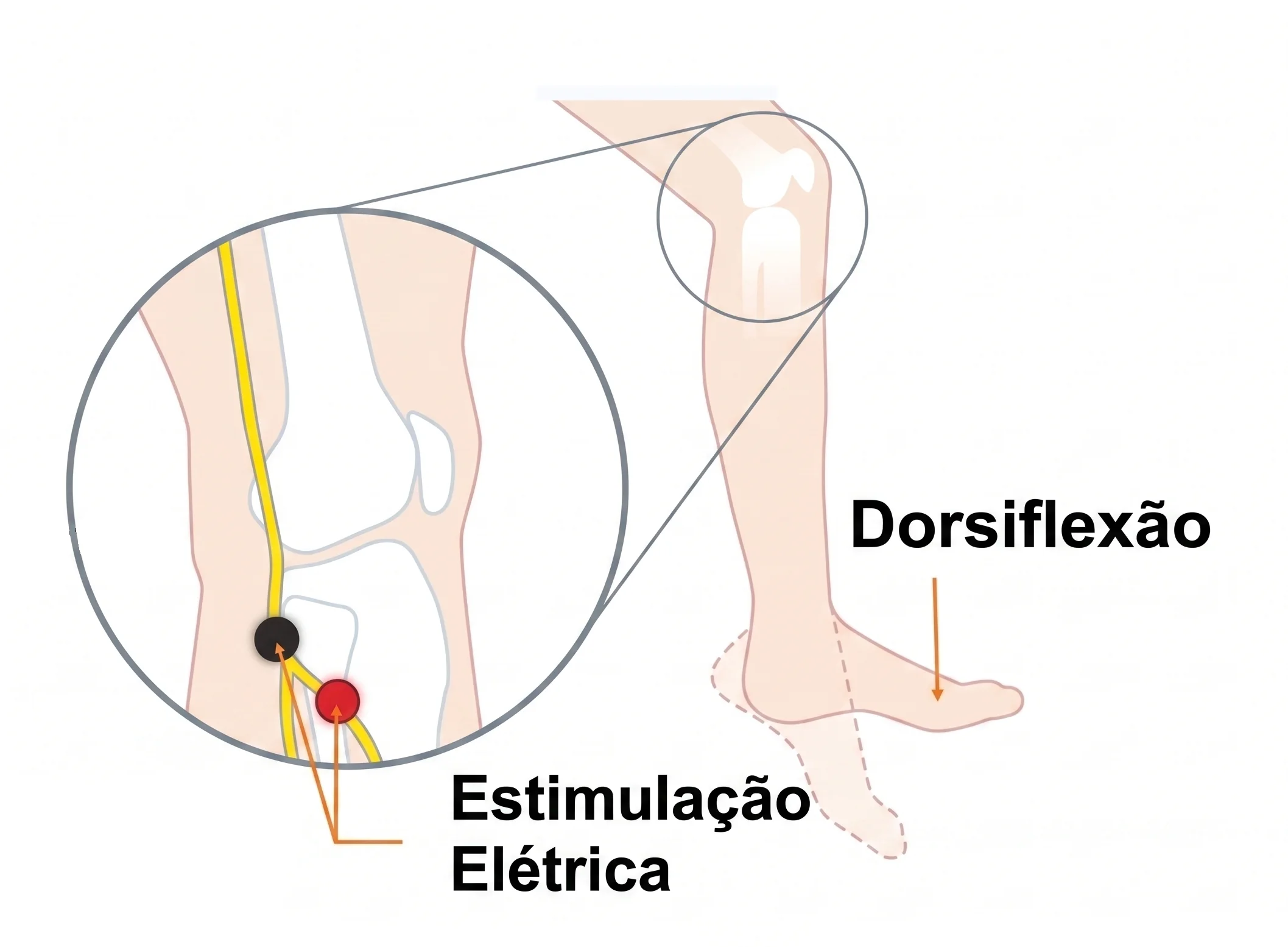 Diagrama anatômico do joelho mostrando o ponto de estimulação elétrica sobre o nervo fibular comum e a dorsiflexão resultante